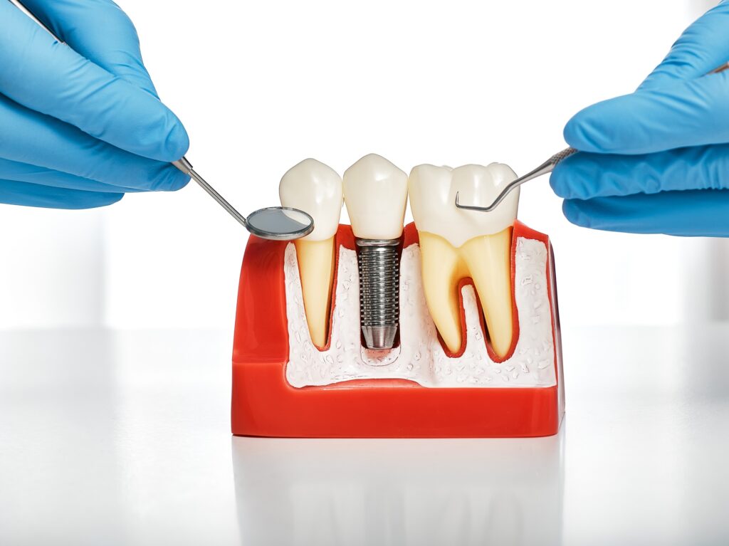 Dentist showing a patient a dental implant model in Alexandria, VA