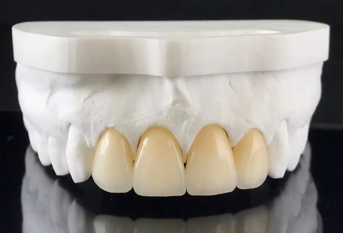 Any teeth can be corrected with dental bridges and crowns, whether the front teeth or back teeth.