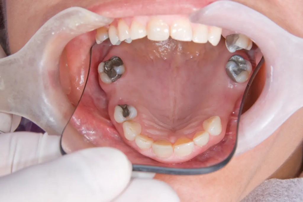 A dentist performs a full mouth reconstruction and full mouth restoration of a smile. Before photo with missing teeth and large fillings.