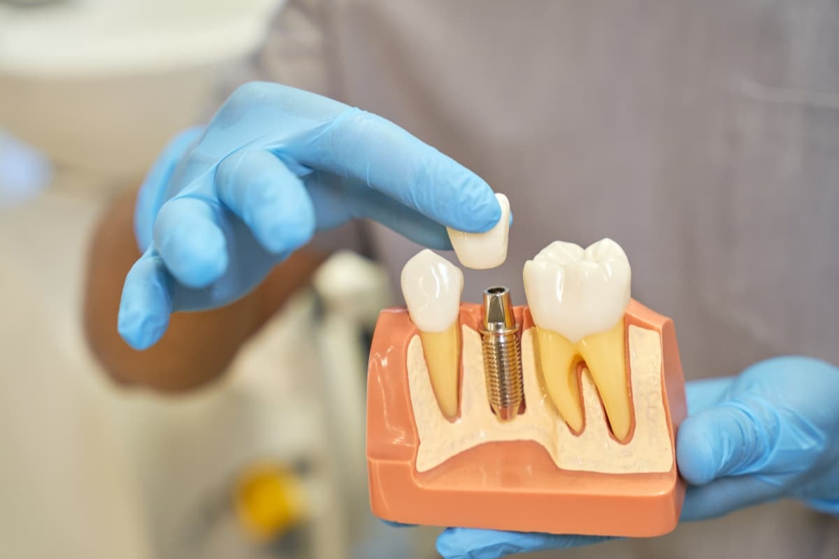 Dental implant model demonstration with gloved hands.
