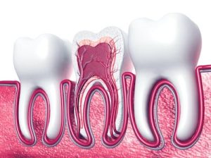 A root canal is a procedure to help save an infected tooth. 