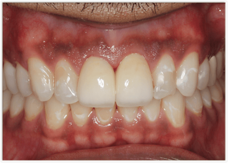 Close-up of human teeth and gums