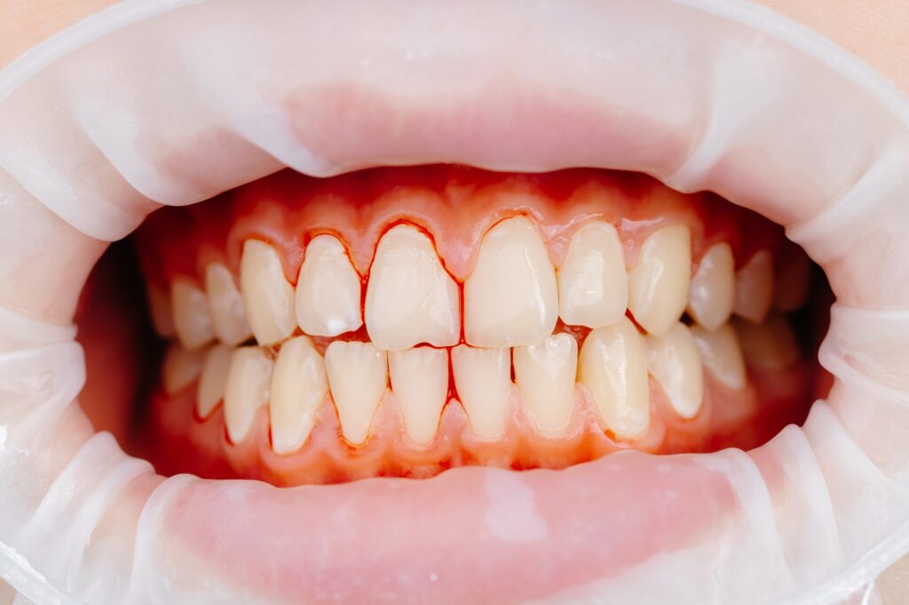 Dentist examining bleeding gums during a periodontal evaluation in Alexandria, VA